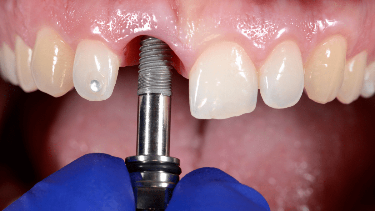 How Dental Implants Work